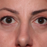 Blepharoplasty and Brow Lift Before & After Patient #34363